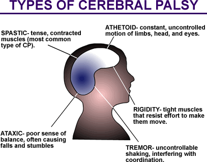 Cerebral Palsy Image